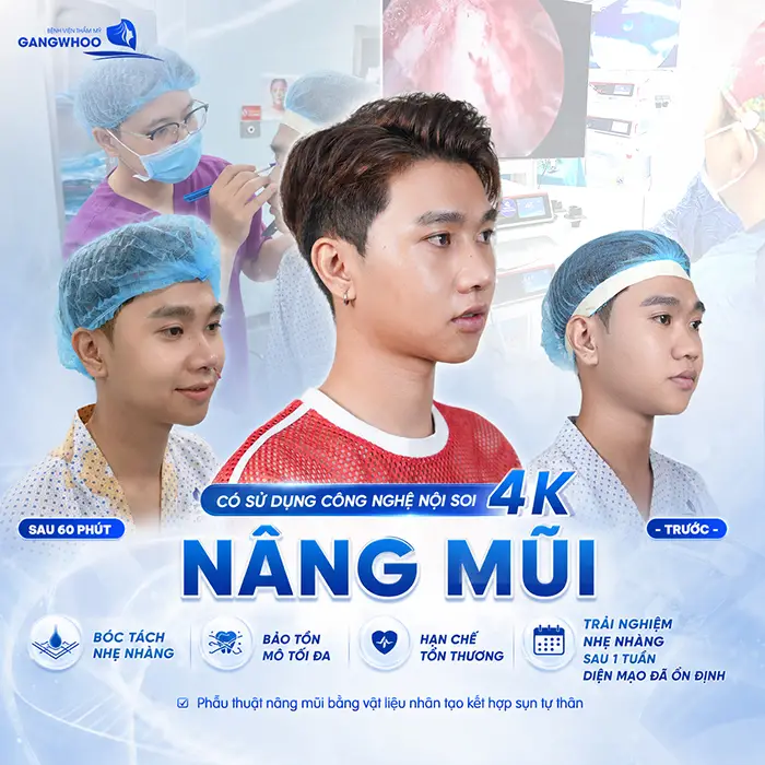 Nâng mũi có sử dụng công nghệ nội soi 4K tải nghiệm nhàng sau 1 tuần diện mạo đã ổn định