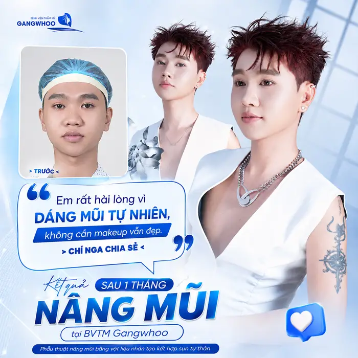 Kết quả sau 1 tháng nâng mũi tại Gangwhoo Chí Nga chia sẻ sử hài lòng và đánh giá cao về kết quả 