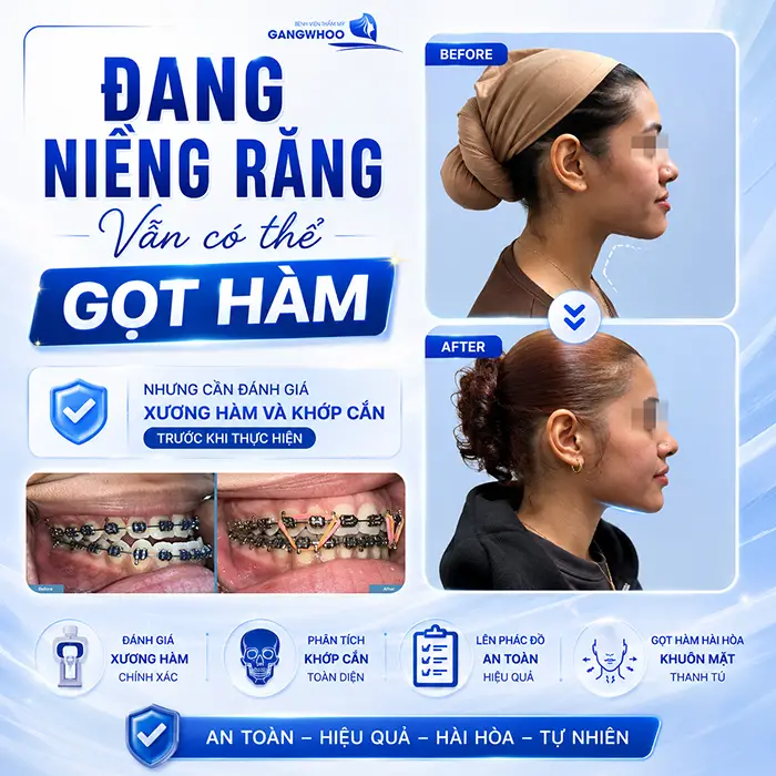 Đang Niềng Răng Có Gọt Hàm Được Không? Bác Sĩ Giải Đáp