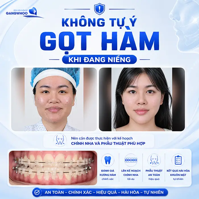 Đang Niềng Răng Có Gọt Hàm Được Không? Bác Sĩ Giải Đáp