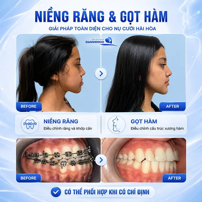 Đang Niềng Răng Có Gọt Hàm Được Không? Bác Sĩ Giải Đáp