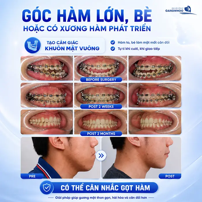 Đang Niềng Răng Có Gọt Hàm Được Không? Bác Sĩ Giải Đáp