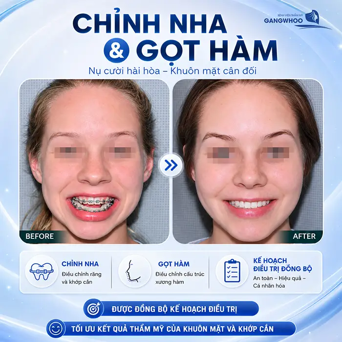 Đang Niềng Răng Có Gọt Hàm Được Không? Bác Sĩ Giải Đáp
