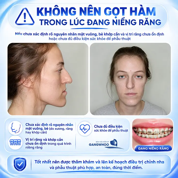 Đang Niềng Răng Có Gọt Hàm Được Không? Bác Sĩ Giải Đáp