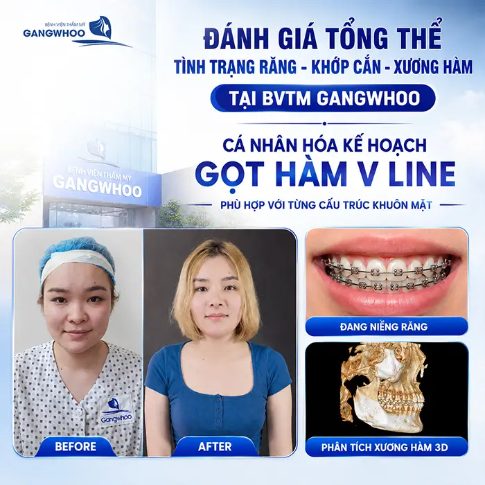 Đang Niềng Răng Có Gọt Hàm Được Không? Bác Sĩ Giải Đáp