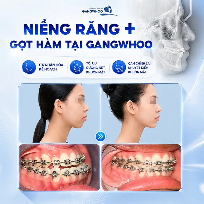 Đang Niềng Răng Có Gọt Hàm Được Không? Bác Sĩ Giải Đáp