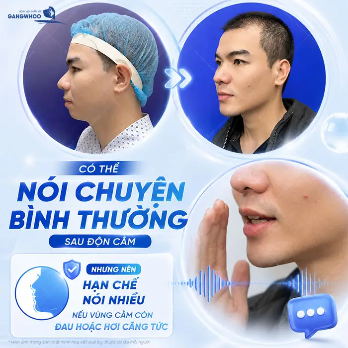 Độn Cằm Bao Lâu Cười Được? Hướng Dẫn Chăm Sóc Để Nhanh Hồi Phục