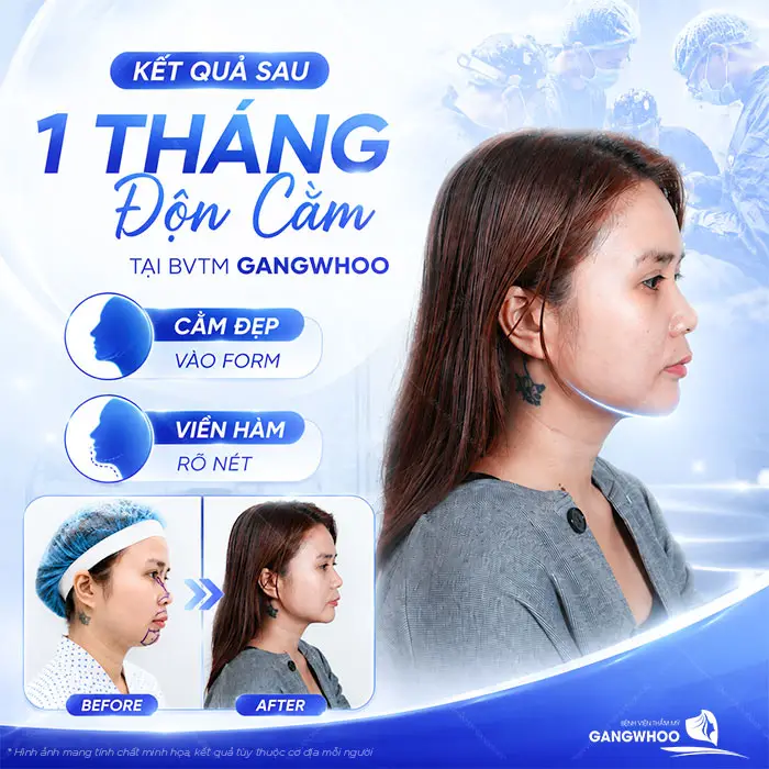 Độn Cằm Bao Lâu Cười Được? Hướng Dẫn Chăm Sóc Để Nhanh Hồi Phục