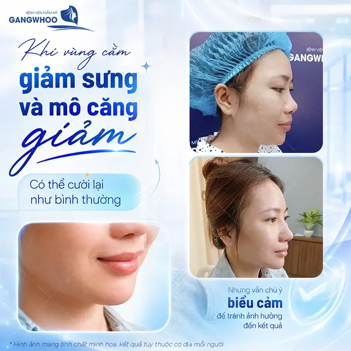 Độn Cằm Bao Lâu Cười Được? Hướng Dẫn Chăm Sóc Để Nhanh Hồi Phục