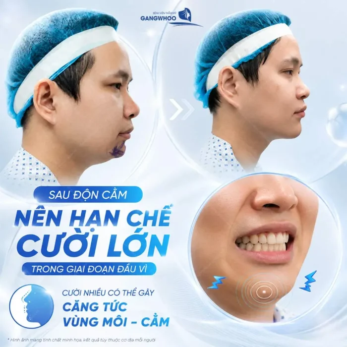 Độn Cằm Bao Lâu Cười Được? Hướng Dẫn Chăm Sóc Để Nhanh Hồi Phục
