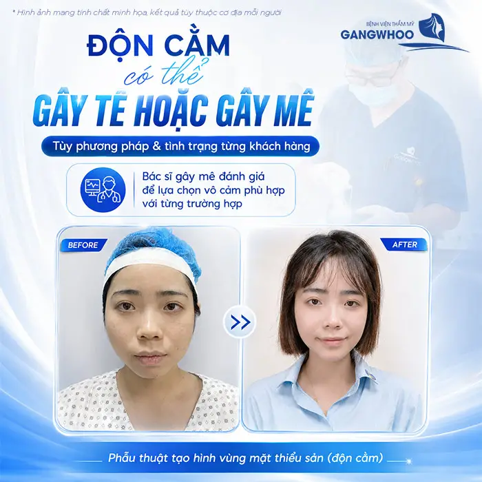 Độn Cằm Có Gây Mê Không? Khi Nào Gây Tê, Khi Nào Gây Mê?