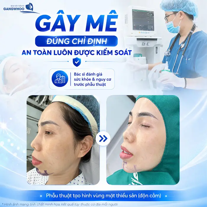 Độn Cằm Có Gây Mê Không? Khi Nào Gây Tê, Khi Nào Gây Mê?