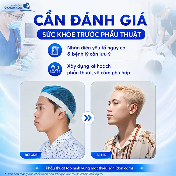 Độn Cằm Có Gây Mê Không? Khi Nào Gây Tê, Khi Nào Gây Mê?
