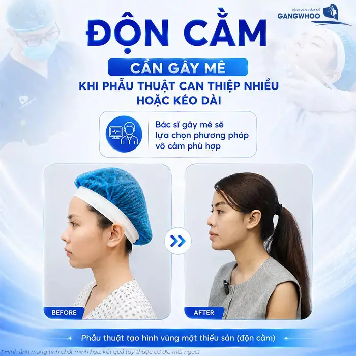 Độn Cằm Có Gây Mê Không? Khi Nào Gây Tê, Khi Nào Gây Mê?