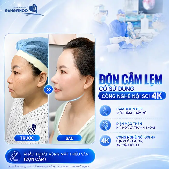 Độn Cằm Lẹm: Giải Pháp Cải Thiện Dáng Cằm Và Đường Nét Khuôn Mặt