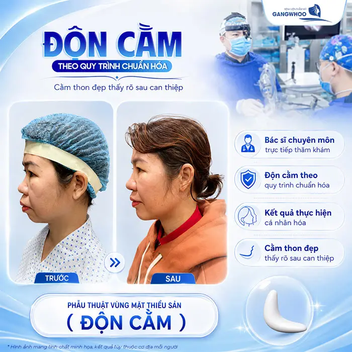 Độn Cằm Lẹm: Giải Pháp Cải Thiện Dáng Cằm Và Đường Nét Khuôn Mặt