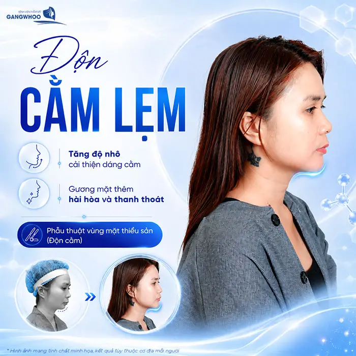 Độn Cằm Lẹm: Giải Pháp Cải Thiện Dáng Cằm Và Đường Nét Khuôn Mặt