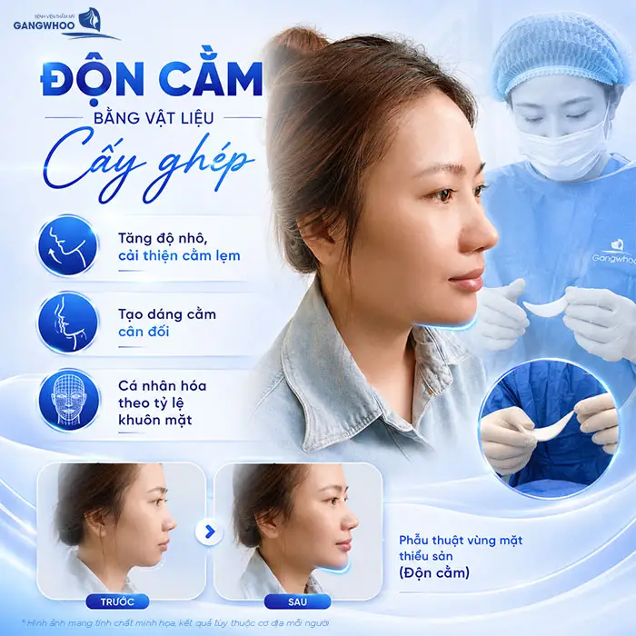 Độn Cằm Lẹm: Giải Pháp Cải Thiện Dáng Cằm Và Đường Nét Khuôn Mặt