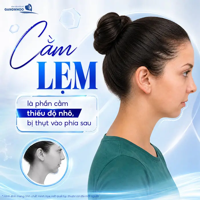 Độn Cằm Lẹm: Giải Pháp Cải Thiện Dáng Cằm Và Đường Nét Khuôn Mặt