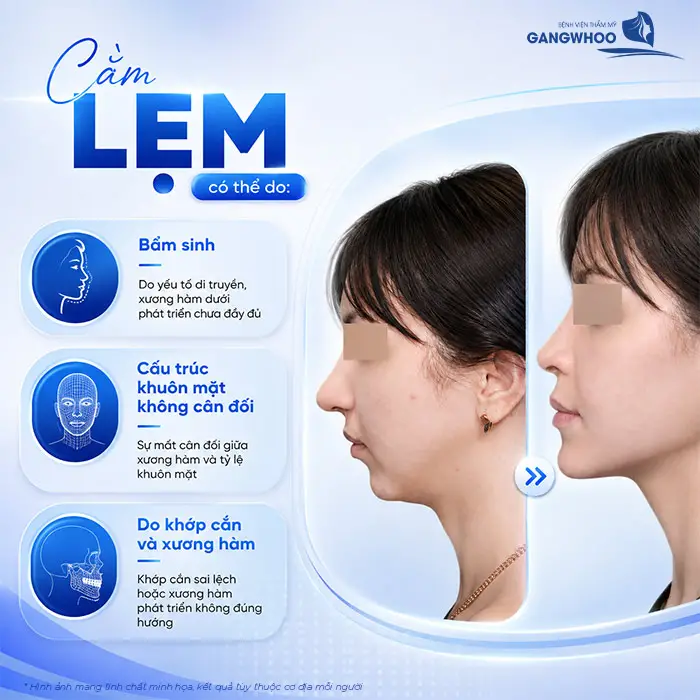 Độn Cằm Lẹm: Giải Pháp Cải Thiện Dáng Cằm Và Đường Nét Khuôn Mặt