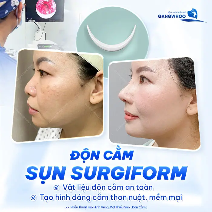 Độn Cằm Sụn Surgiform Là Gì? Chi Phí Bao Nhiêu? 1 Độn Cằm Sụn Surgiform Là Gì? Chi Phí Bao Nhiêu?
