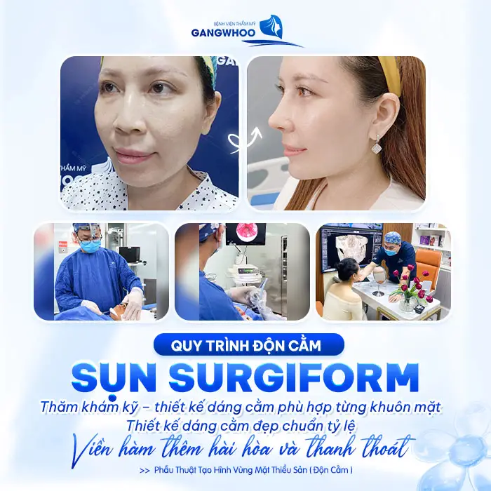 Độn Cằm Sụn Surgiform Là Gì? Chi Phí Bao Nhiêu? 4 Độn Cằm Sụn Surgiform Là Gì? Chi Phí Bao Nhiêu?
