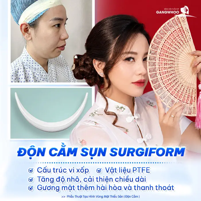 Độn Cằm Sụn Surgiform Là Gì? Chi Phí Bao Nhiêu? 2 Độn Cằm Sụn Surgiform Là Gì? Chi Phí Bao Nhiêu?