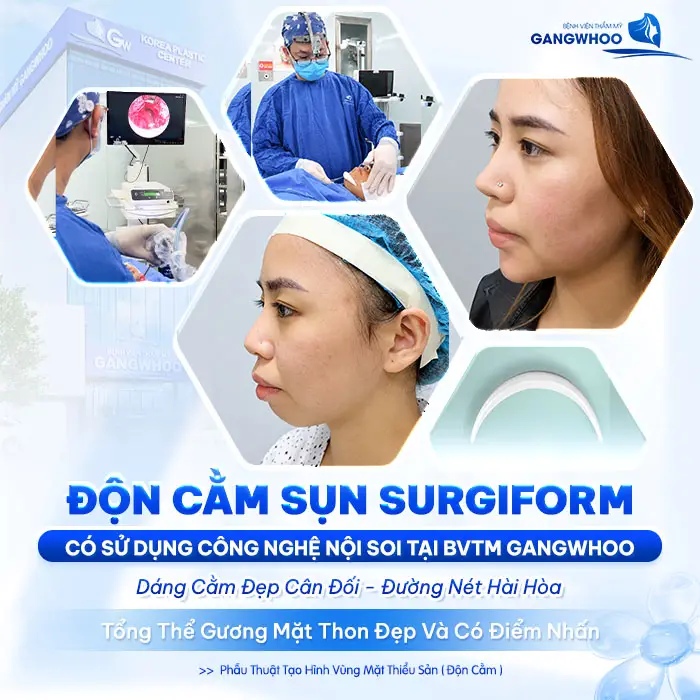 Độn Cằm Sụn Surgiform Là Gì? Chi Phí Bao Nhiêu? 6 Độn Cằm Sụn Surgiform Là Gì? Chi Phí Bao Nhiêu?