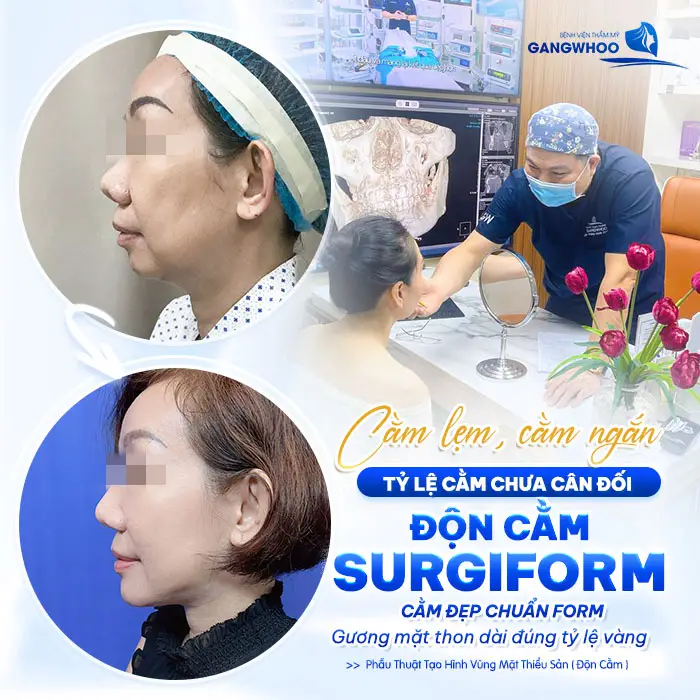Độn Cằm Sụn Surgiform Là Gì? Chi Phí Bao Nhiêu? 3 Độn Cằm Sụn Surgiform Là Gì? Chi Phí Bao Nhiêu?