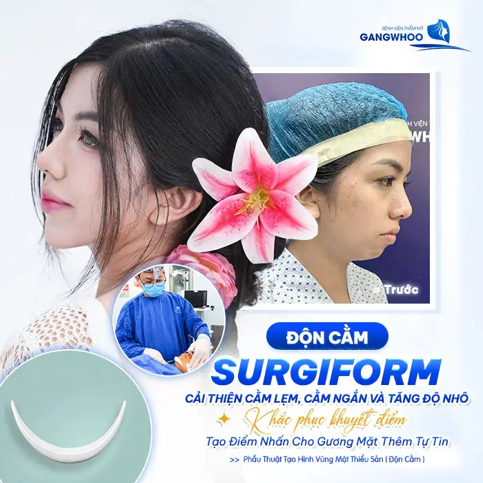 Độn Cằm Sụn Surgiform Là Gì? Chi Phí Bao Nhiêu? 5 Độn Cằm Sụn Surgiform Là Gì? Chi Phí Bao Nhiêu?