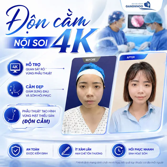 Độn Cằm Có Đau Không? Mức Độ Đau Và Thời Gian Hồi Phục