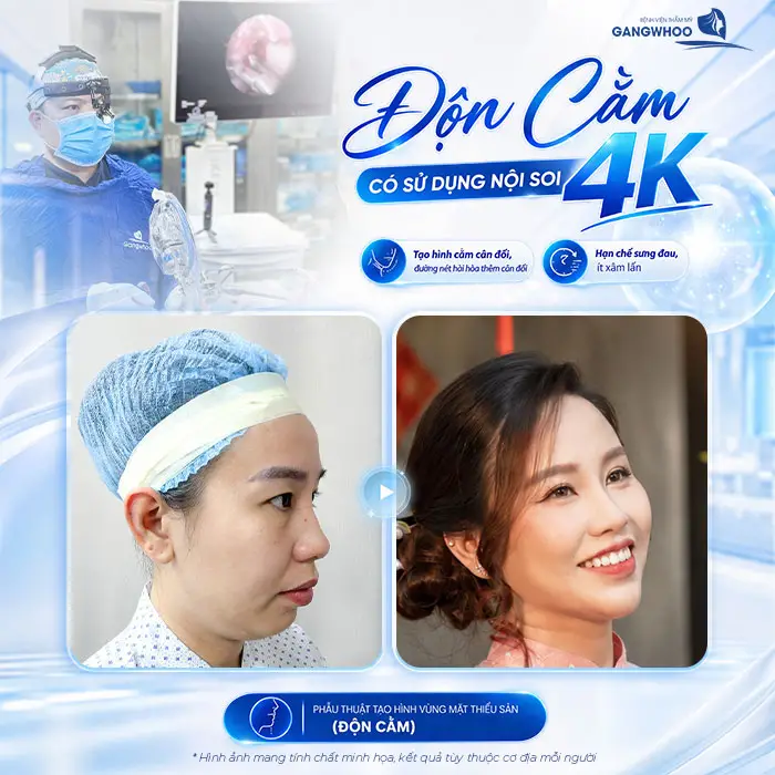 Độn Cằm Có Đau Không? Mức Độ Đau Và Thời Gian Hồi Phục