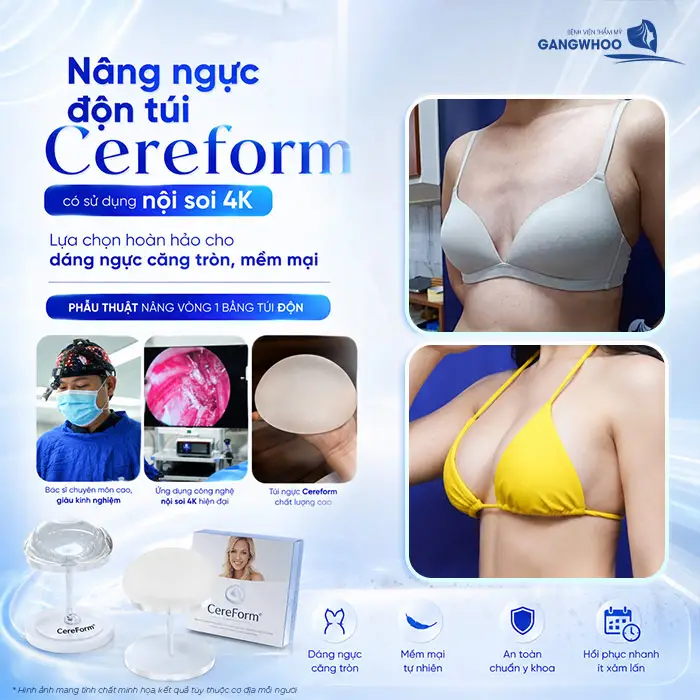 Nâng Ngực Túi CereForm Từ Pháp: Đa Dạng Kích Thước, Cá Nhân Hóa Lựa Chọn 