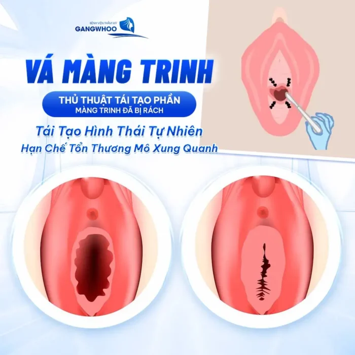 Vá Màng Trinh Có Nguy Hiểm Không? Giải Đáp Từ Góc Nhìn Chuyên Môn

