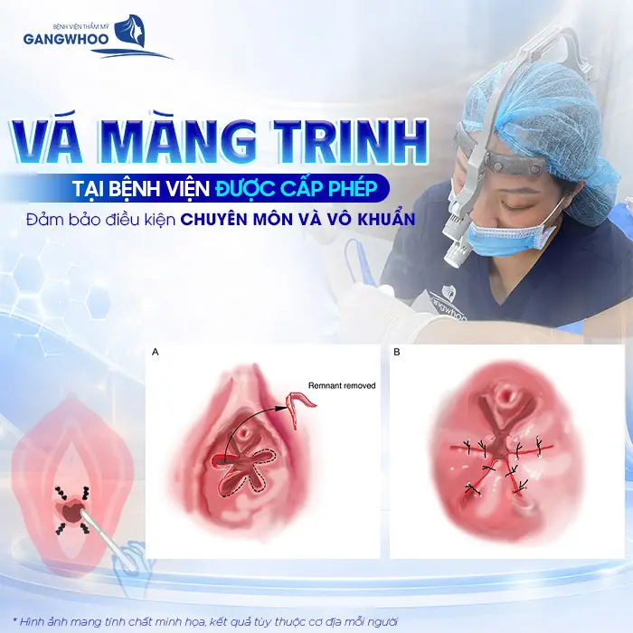 Vá Màng Trinh Có Nguy Hiểm Không? Giải Đáp Từ Góc Nhìn Chuyên Môn