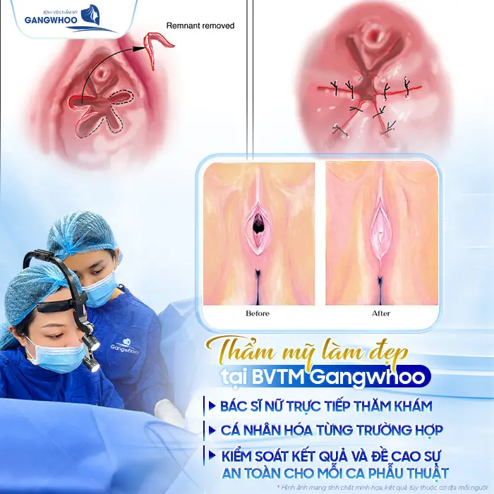 Vá Màng Trinh Được Không Khi Đã Quan Hệ Nhiều Lần? Bác Sĩ Giải Đáp