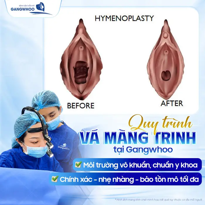 Vá Màng Trinh Được Không Khi Đã Quan Hệ Nhiều Lần? Bác Sĩ Giải Đáp