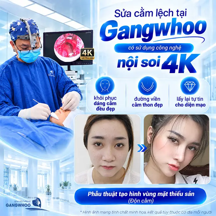 Độn Cằm Bị Lệch Phải Làm Sao? Nguyên Nhân Và Cách Khắc Phục An Toàn