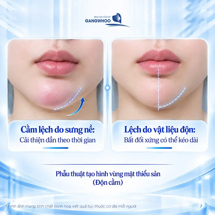 Độn Cằm Bị Lệch Phải Làm Sao? Nguyên Nhân Và Cách Khắc Phục An Toàn