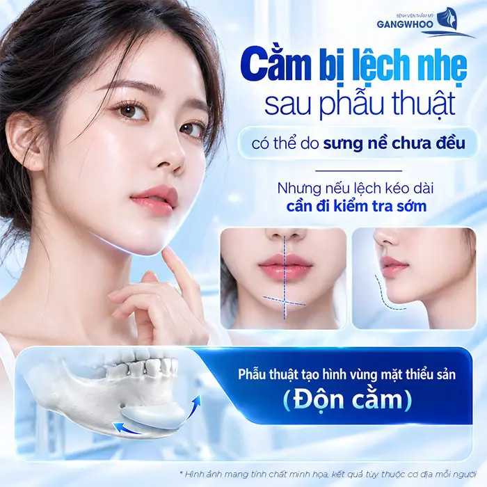 Độn Cằm Bị Lệch Phải Làm Sao? Nguyên Nhân Và Cách Khắc Phục An Toàn