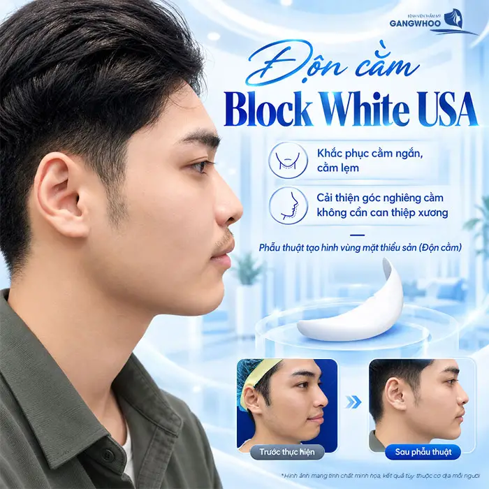 Độn cằm Block White USA khắc phục dáng cằm ngắn, cằm lẹm giúp cải thiện cằm không cần can thiệp xương