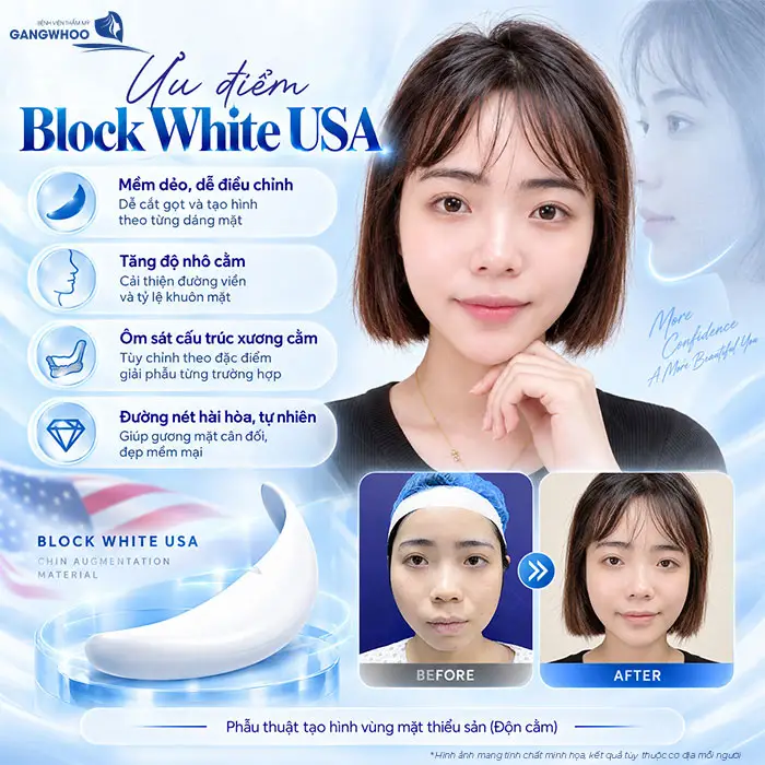 Ưu điểm Block White USA mềm dẻo, dễ điều chỉnh hoặc tăng độ nhô cho dáng cằm 