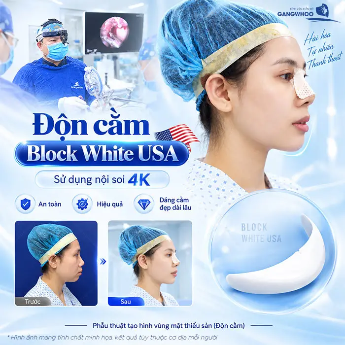 Độn cằm sụn Block White USA an toàn, hiệu quả duy trì dáng cằm đẹp bền lâu 