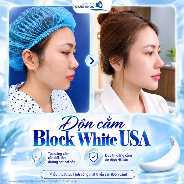 Độn cằm Block White USA tạo dáng cằm cân đối, tôn đường nét hài hòa cho diện mạo 