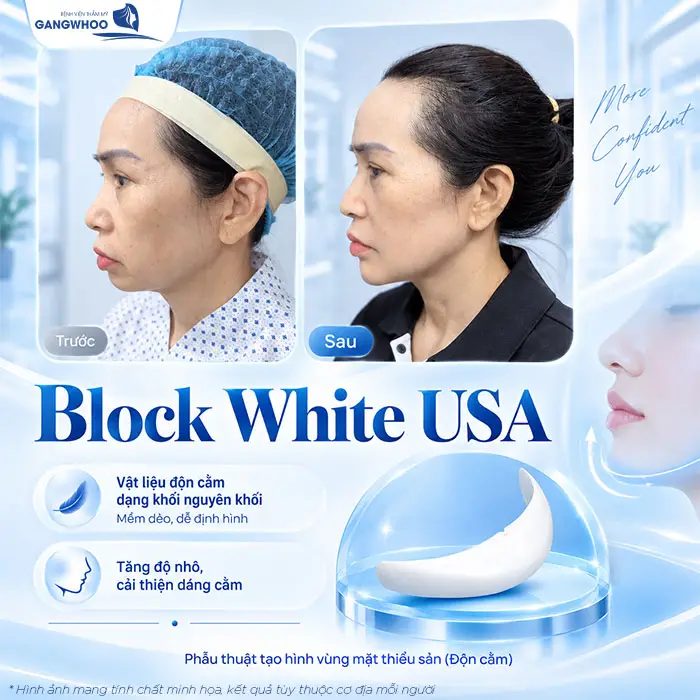 Sụn độn cằm Block White USA là vật liệu độn cằm dạng khối giúp tăng độ nhô và cải thiện dáng cằm 