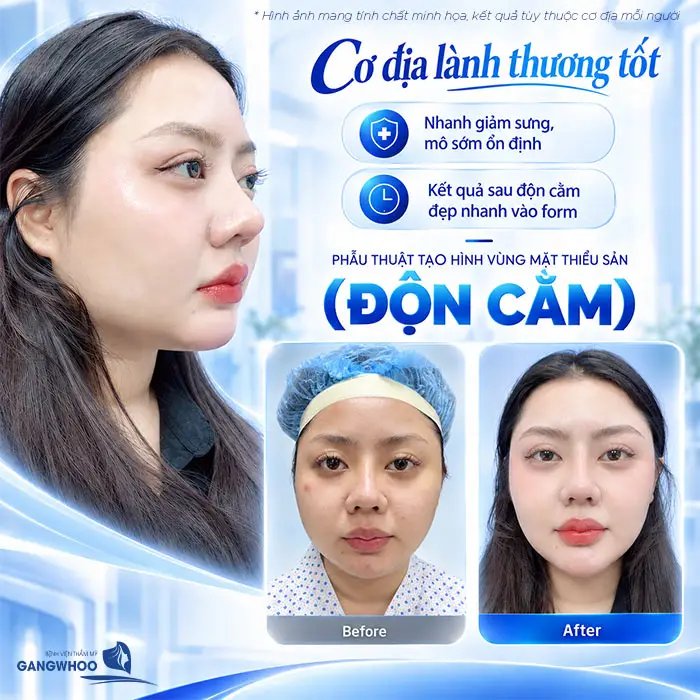 Độn Cằm Có Được Vĩnh Viễn Không? Những Yếu Tố Ảnh Hưởng