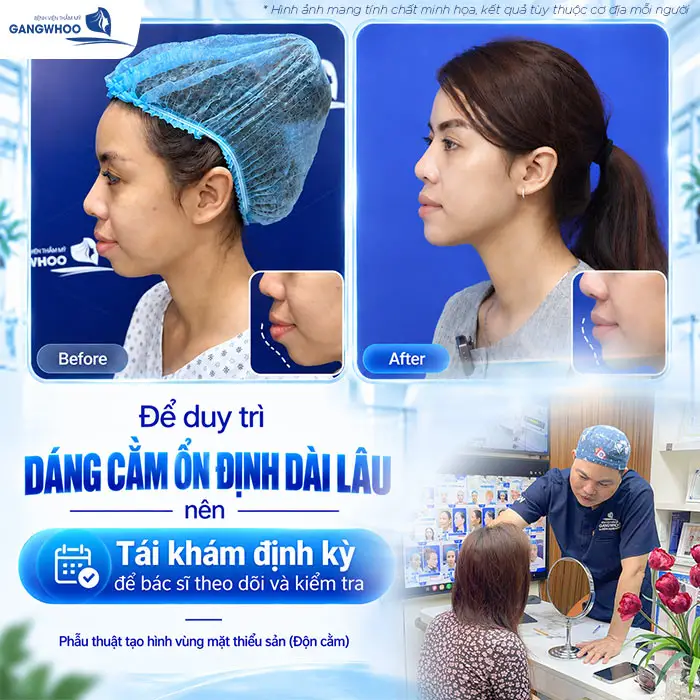 Độn Cằm Có Được Vĩnh Viễn Không? Những Yếu Tố Ảnh Hưởng