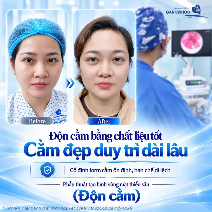 Độn Cằm Có Được Vĩnh Viễn Không? Những Yếu Tố Ảnh Hưởng