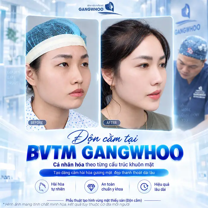 Độn Cằm Có Được Vĩnh Viễn Không? Những Yếu Tố Ảnh Hưởng