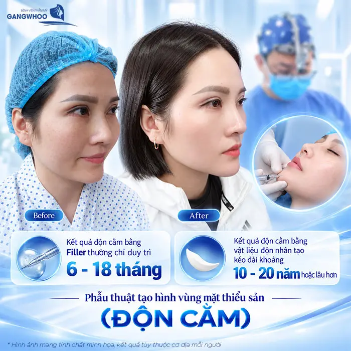 Độn Cằm Có Được Vĩnh Viễn Không? Những Yếu Tố Ảnh Hưởng